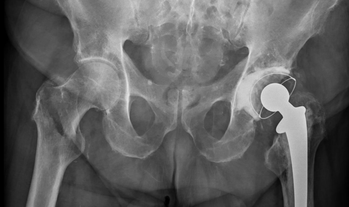 Geriatric hip fractures: The global burden and the JHH experience