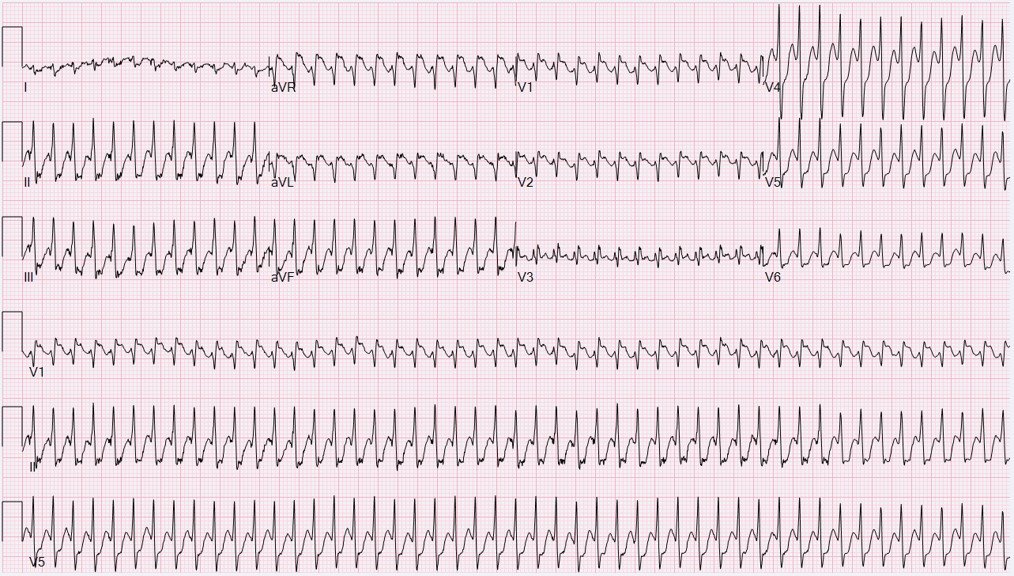 ECG interpretation