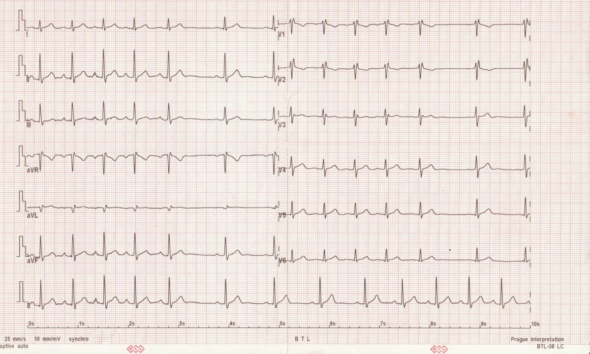 Rhythm interpretation and management: Guide to arrhythmias