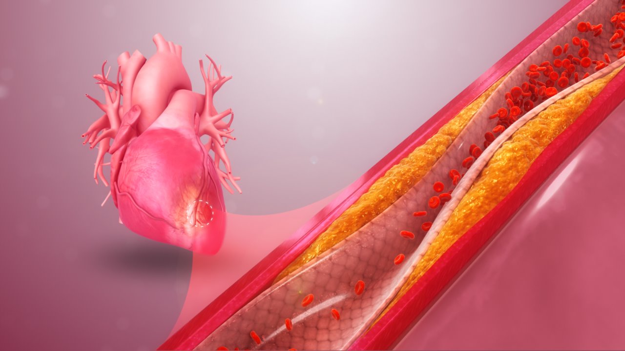 Non-invasive investigations for coronary artery disease