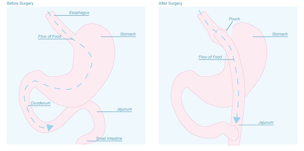 Bariatrics Complications