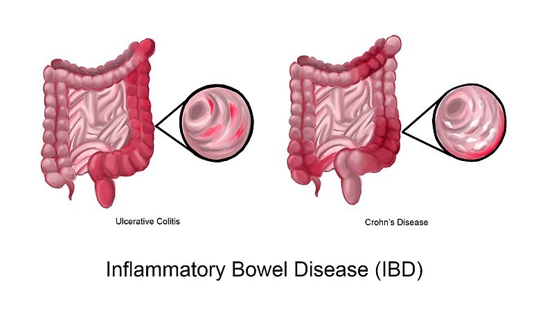 Inflammatory bowel disease for surgeons