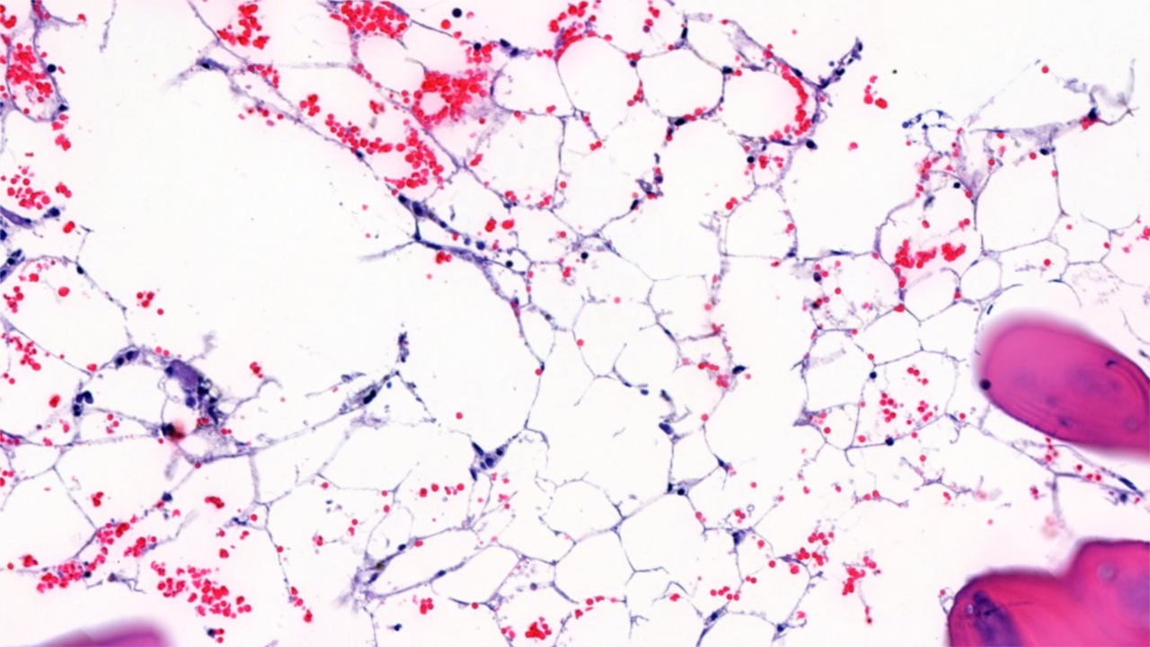 A returned traveller with cytopenias