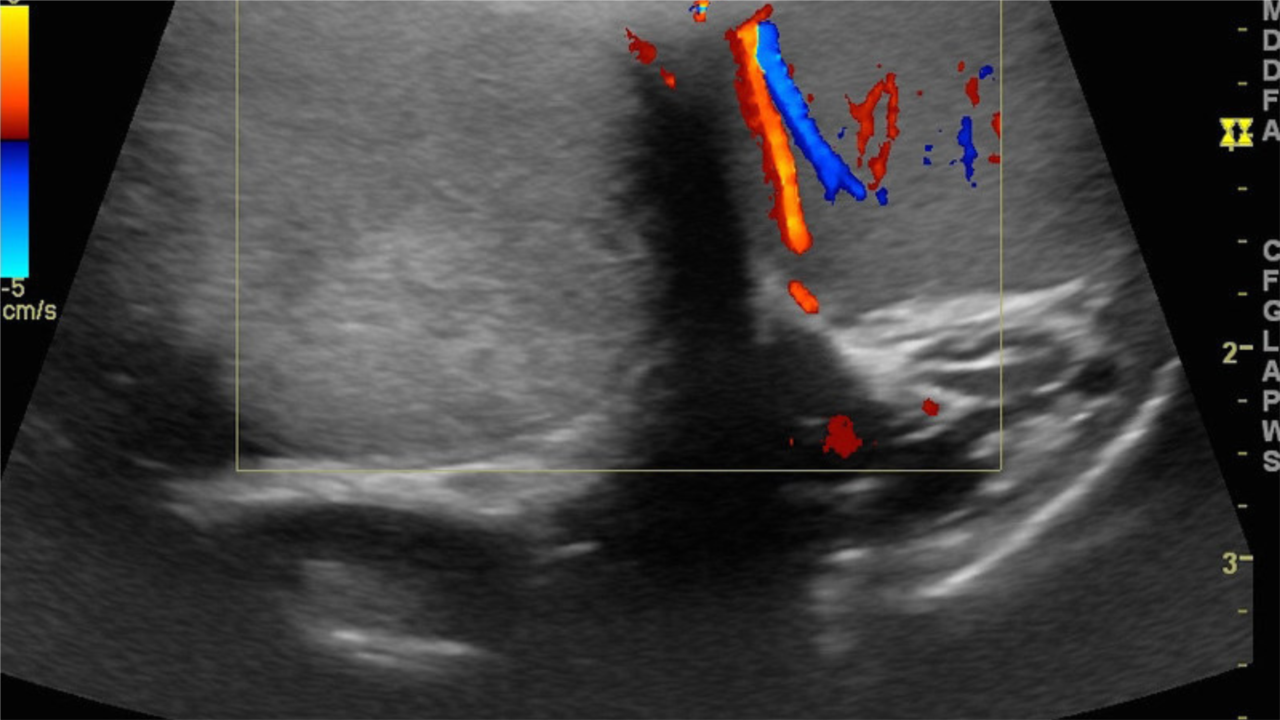 Testicular torsion