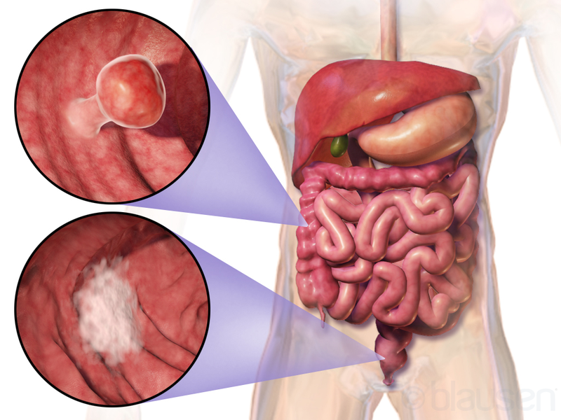 Colorectal vivas 