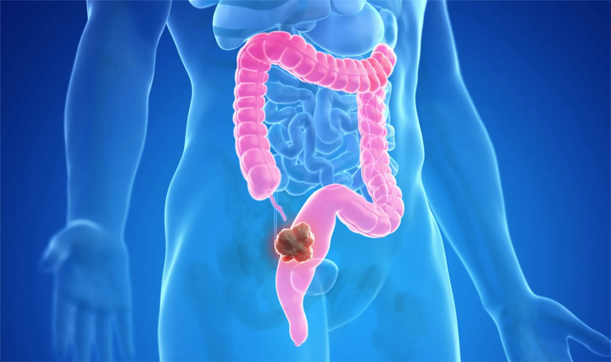 Polyp assessment, classification and management